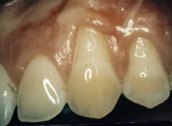 Before photo of gum graft patient - Periodontist in Forsyth IL