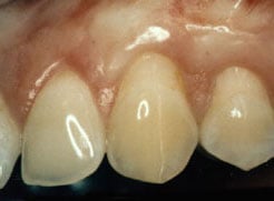After photo of gum graft patient - Periodontist in Forsyth IL