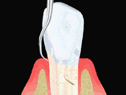 Animated gif of Root Planing procedure - Periodontist in Forsyth IL