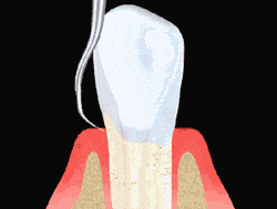 Animated gif of Tooth Scaling procedure - Periodontist in Forsyth IL